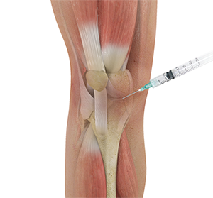 Knee Injection
