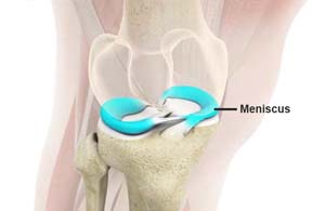 Knee Microfracture