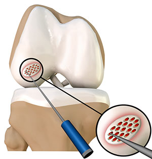 Meniscal Tears