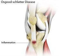 Osgood-Schlatter Disease